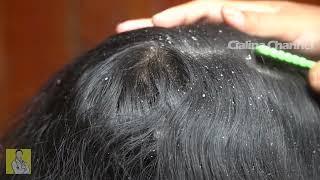 Satisfying Extremely Damaged Dandruff Scratching 2524