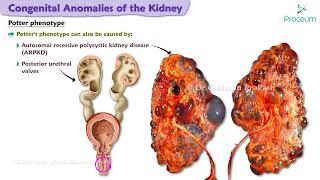 Congenital Anomalies Of The Kidney🩺  | Nephrology Lectures