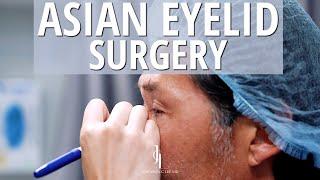 Asian Eyelid Surgery with Results