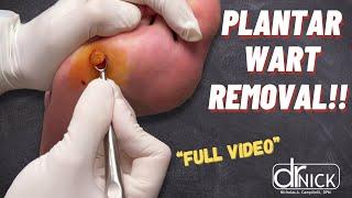 How Plantar Warts are Removed | Office Surgery | Dr. Nick Campitelli
