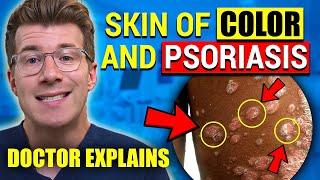 Skin of Color and Psoriasis: Visual Signs & Symptoms| Doctor Explains