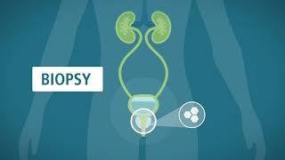 Prostate Biopsy: What You Should Know - Urology Care Foundation