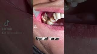 Dental Cleaning, Dental Scaling #tiktok #viral #video #fyp #funny #love #dentist