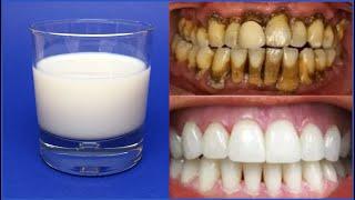 Teeth Whitening in Just 3 - How to Whiten Teeth at Home?  100% efficacy