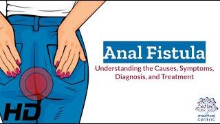 Anal Fistula Explained: Causes, Symptoms, and Treatment