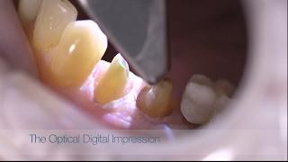 Digital Optical Dental Impression