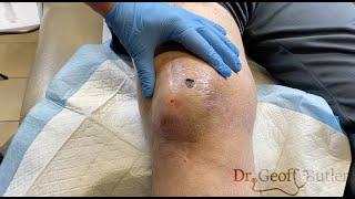 Drainage of a knee hematoma