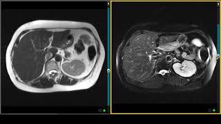 T2 Turbo Spin Echo Sequence on MRI - Liver Protocols