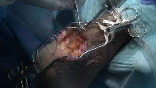 Insertional Achilles Repair Feat Dr. Sarang Desai