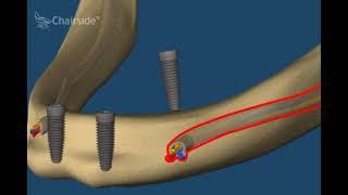 вся нижняя челюсть на 4 имплантатах