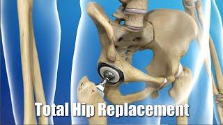 Total Hip Replacement