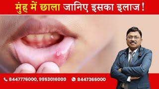 Mouth ulcers : Know why they happen? | By Dr. Bimal Chhajer | Saaol