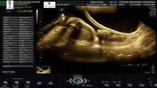 PARTUS PREMATURUS IMMINENS 29-30 WEEKS (Dr Wiku Andonotopo)