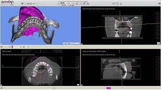 Smop: How to Align STL File with CBCT Scan