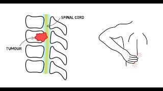 Spinal Cord Compression