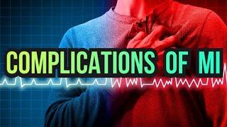 Complications of Myocardial Infarction (updated 2023) - CRASH! Medical Review Series