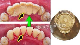 The most effective and tested solution to eliminate dental plaque quickly