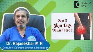 ANAL SKIN TAGS -Irritating down there? Cause,Symptom & Treatment-Dr.Rajasekhar M R | Doctors' Circle