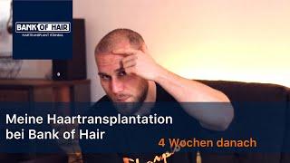 Haartransplantation Türkei - 4 Wochen nach meiner HT