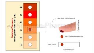 Estimation of Haemoglobin | Colour Scale Method to Determine Haemoglobin in Blood Sample | Animation