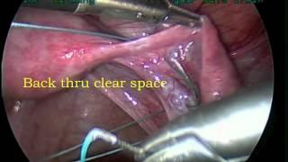 Laparoscopic Oophoropexy - Ovarian Suspension