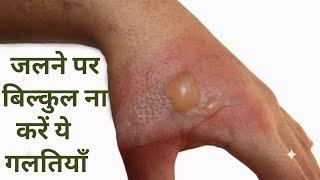 10 Home Remedies in Hindi to treat Skin Burn: जलने पर तुरंत अपनाएं ये घरेलू उपचार | Jeevan Kosh
