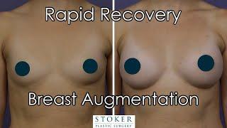 Rapid Recovery Breast Augmentation: Los Angeles Top Breast Surgeon Dr. David Stoker Describes