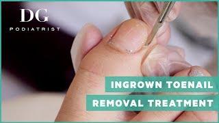 Ingrown toenail removal treatment