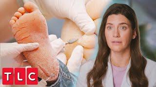 Incredibly Deep Fissures: Dr. Sarah Breaks Out the Medical Dremel | My Feet Are Killing Me