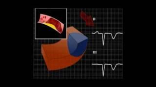 EKG zawał 1