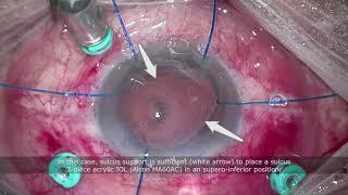 15 Tips for Dropped Nucleus Surgery - Dr Sami A. Saad