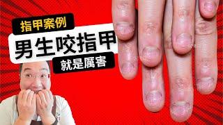 男生咬指甲就是厲害