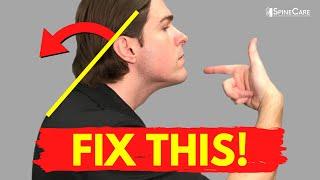 How to Fix Forward Head Posture for Good