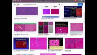 USMLE Crash Course - MASSIVELY IN-DEPTH RIPE Therapy Analysis (TB) Step 1 / Step 2 CK / USMLE