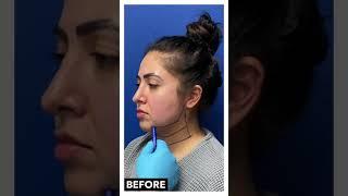 Reno Awake Neck Liposuction With RF Skin Tightening | FaceTite Lake Tahoe | Avance Plastic Surgery