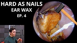 Hard As Nails Ear Wax EPISODE 4