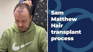 Sam Matthew Hair Transplant Process