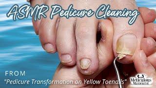 ASMR Pedicure Cleaning ‍️ Pedicure Transformation on Yellow Toenails
