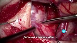 Иссечение АВМ с выраженным кровотечением во время операции. Нейрохирург Царикаев А.В.