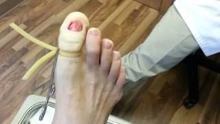 Permanent toenail removal in less than 4 minutes