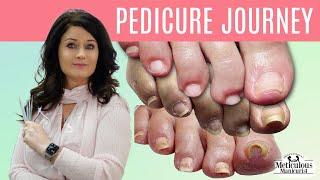 Pedicure Transformation Compilation on Squeezed Toenails