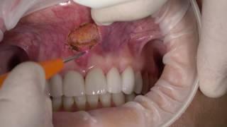 Frenectomy Procedure with Dental Laser Video