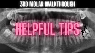 Third Molar Extraction Video | Helpful Tips | OnlineExodontia.com