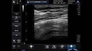 Transversus thoracic muscle plane block-01