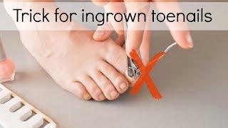 How to Fix Ingrown Toenails Easily