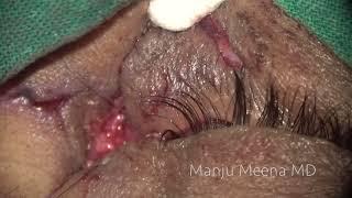 Canalicular tear repair with monocanalicular stent by Dr Manju Meena