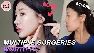 [SUB]Ep.2: New Update on a 6-month Post Surgery of Multiple Procedures here at Nana Plastic Surgery!