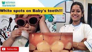 White spots on Baby's teeth | Mithran Dental | Dr Jayalakshmi | Chennai | Adyar