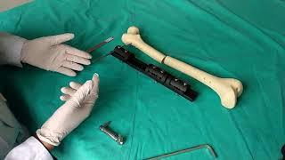 LRS Limb Lengthening External Fixator Surgical Technique