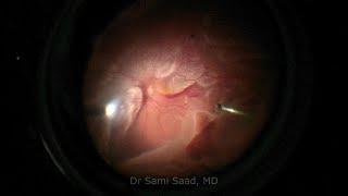 Traumatic Retinal Detachment - Tips & tricks | Dr Sami A. Saad